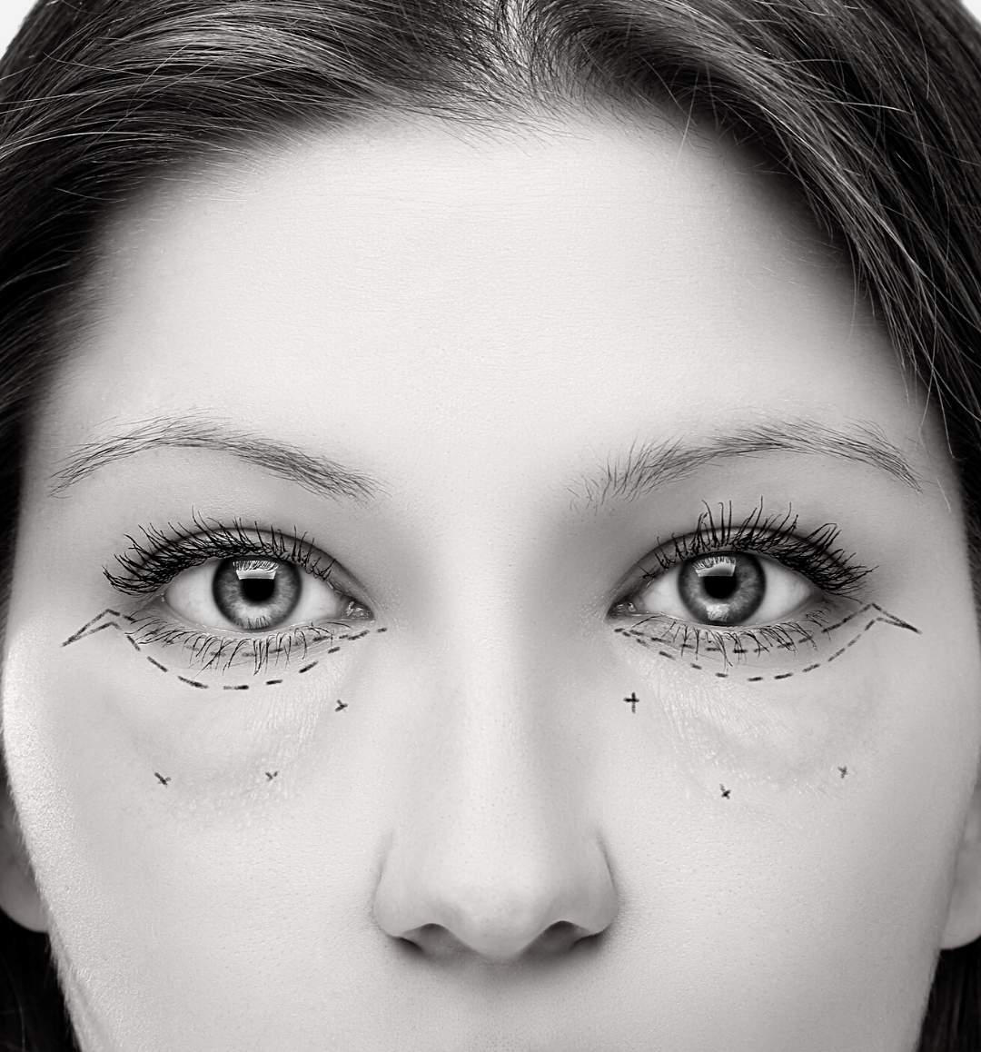 Plastie abdominale ventre plat - Dr Samouh SAMOUH